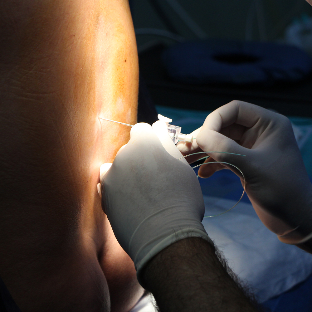 Anaesthetist administers epidural in surgery