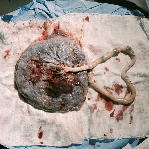 Placenta immediately after birth and delivery, with cord laying in heart shape
