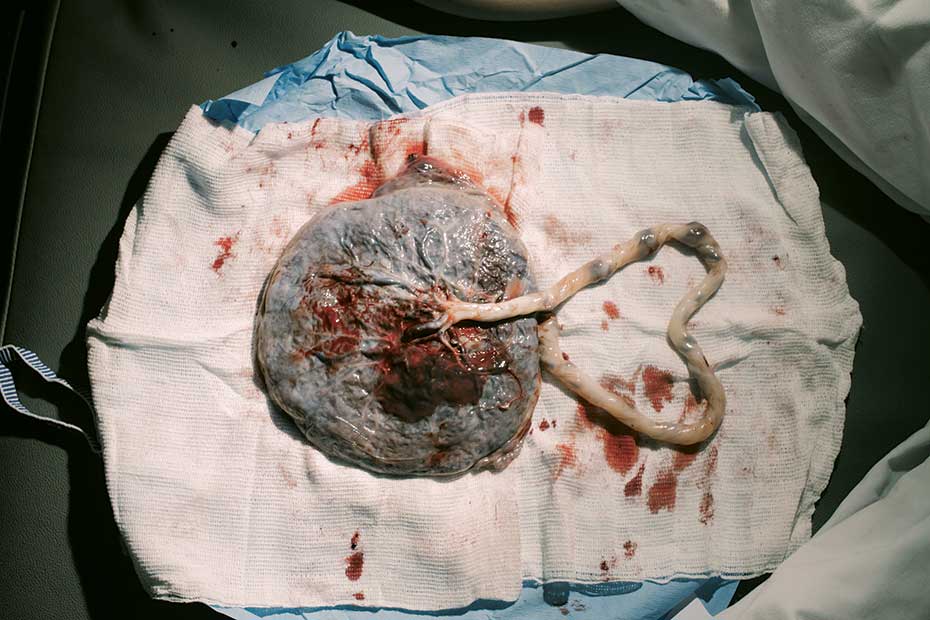 placenta birth