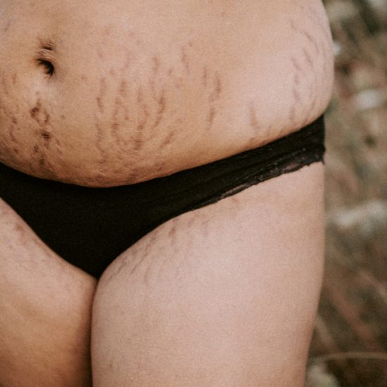 Woman's stretch marks on body from pregnancy