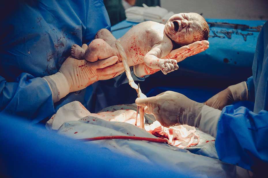 Live birth: C-section surgery 