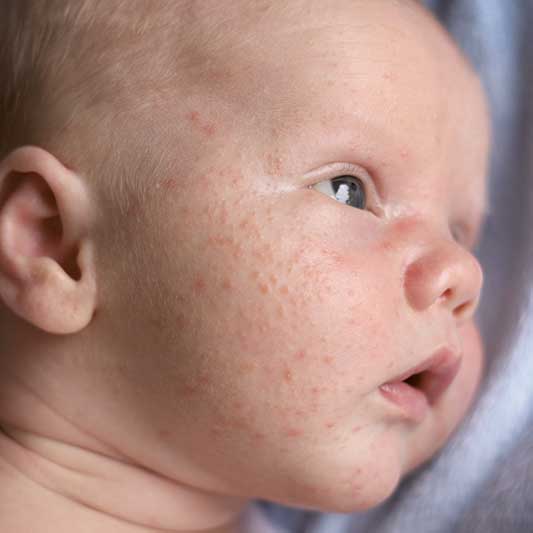 Newborn with baby acne on cheeks