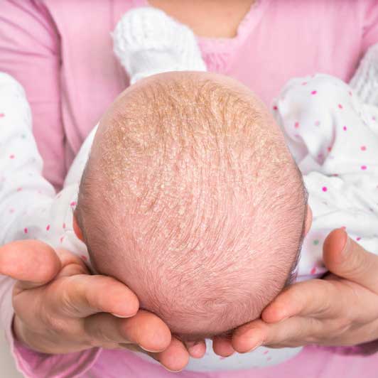 Cradle cap in newborn baby