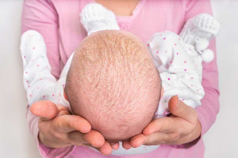 Cradle Cap In Newborns What It Is And How To Effectively Remove It