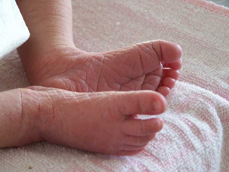 Kænguru hvidløg Footpad Skin Peeling on Your Newborn Baby? How to Help Their Dry Skin