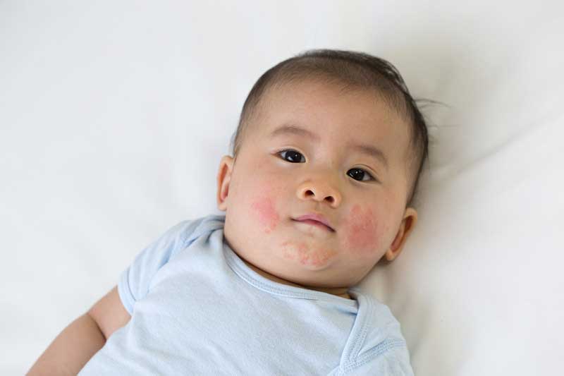 Baby with eczema