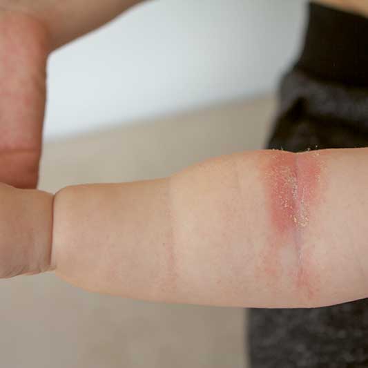 Eczema is common in babies