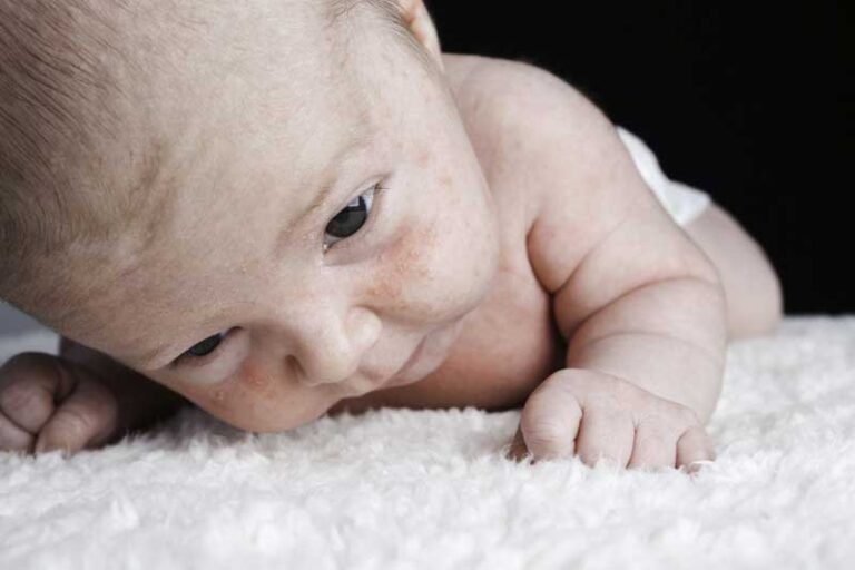 Milk Spots Milia In Newborns What Are They How Are They Treated 